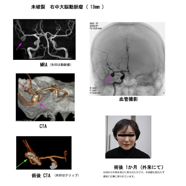 動脈瘤の治療方法（1）開頭手術｜昭和大学医学部 脳神経外科学教室